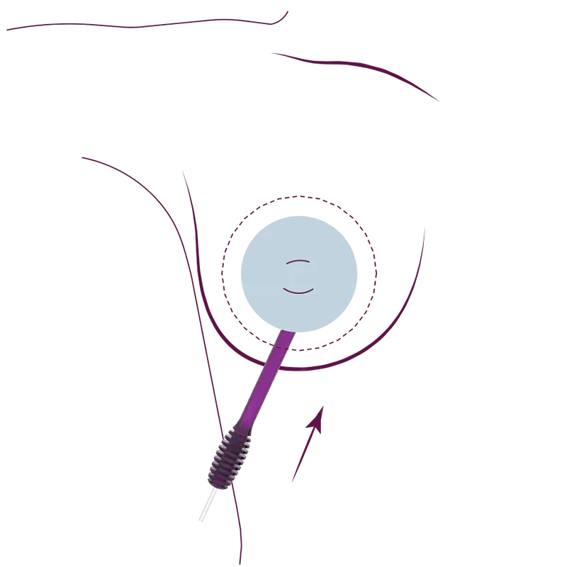 brustvergrößerung ohne vollnarkose