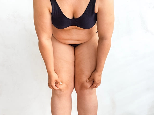 fettabsaugung beine kosten, fettabsaugung reiterhosen, fettabsaugung beine, fettabsaugung oberschenkel, oberschenkel fett loswerden, knie fett loswerden, fett knie innenseite loswerden fettabsaugung beine kosten, fettabsaugung reiterhosen, fettabsaugung beine, fettabsaugung oberschenkel, oberschenkel fett loswerden, knie fett loswerden, fett knie innenseite loswerden